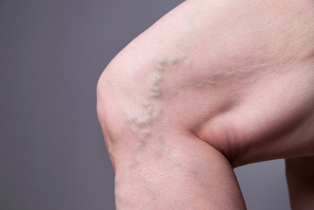 Varicose veins on the leg