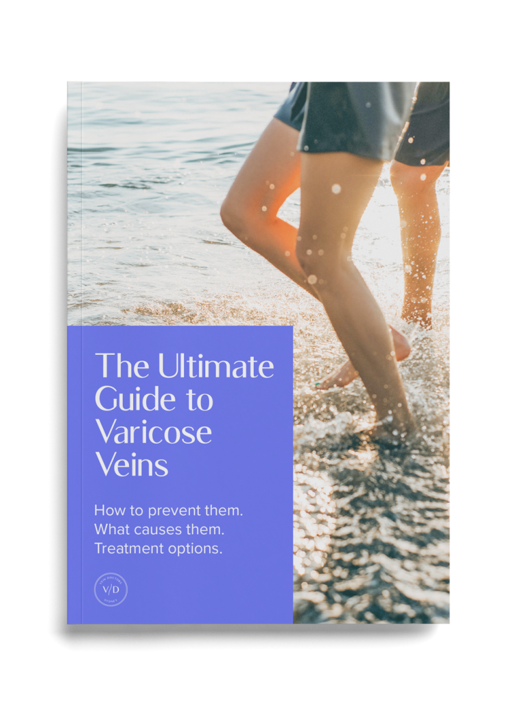 ultimate guide to varicose veins
