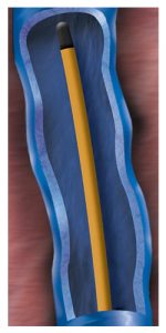 Radiofrequency Ablation RFA - Varicose Veins Treatment