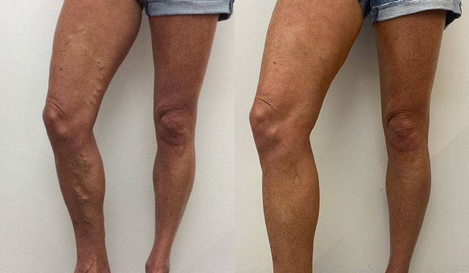 What Is The Main Cause Of Varicose Veins? 