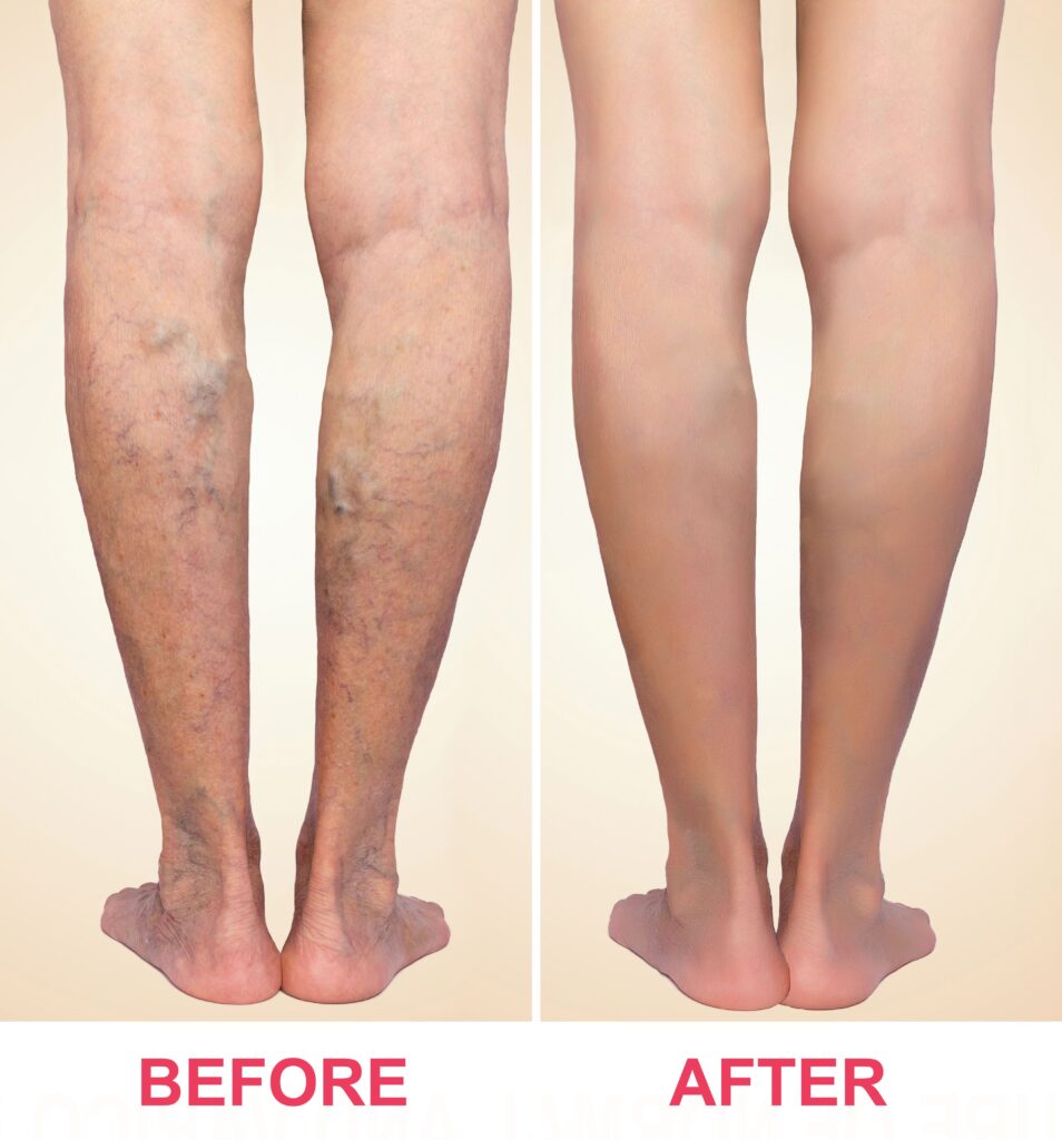 does medicare cover vein treatment