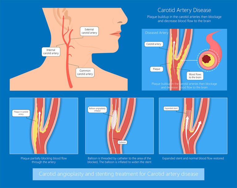 Carotid Artery Disease | Vein Doctors Sydney