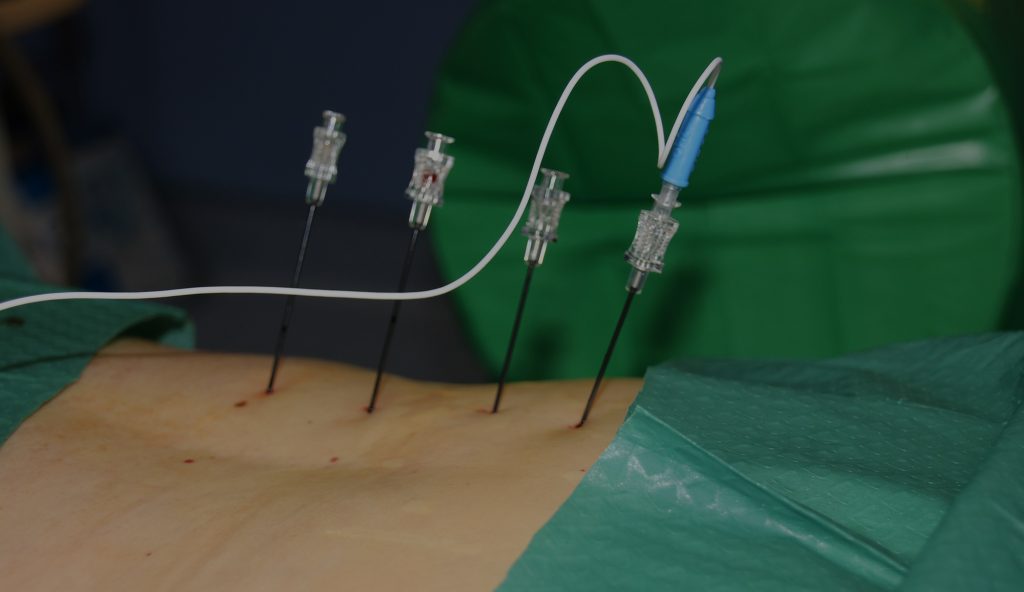 Interventional Pain Management | Chronic Pain Management | Pain Management Techniques