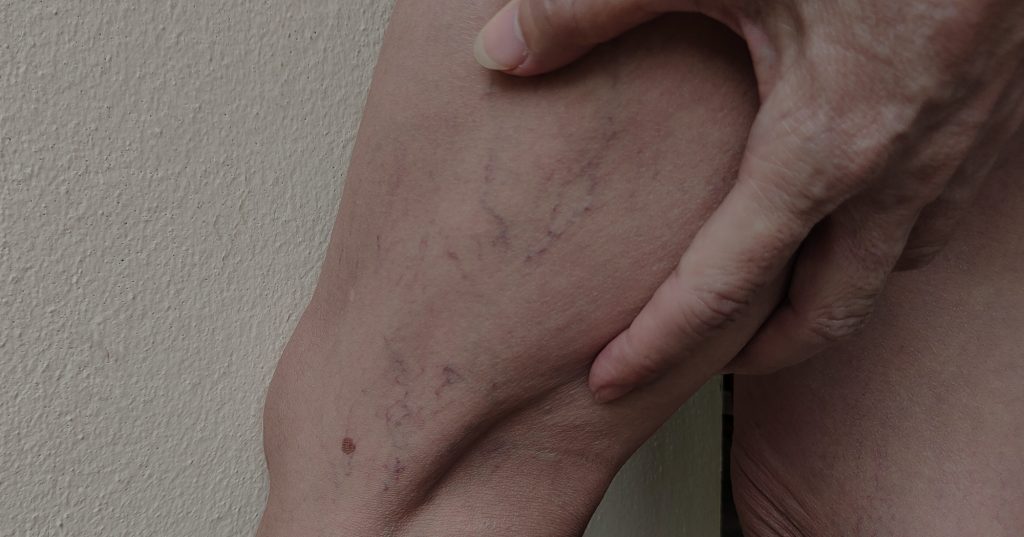 spider veins vs varicose veins what causes varicose veins varicose veins medical procedure what do spider veins look like difference between spider veins and varicose veins how to identify varicose veins