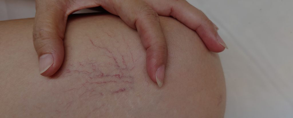 How To Not Get Spider Veins | Spider Veins Prevention