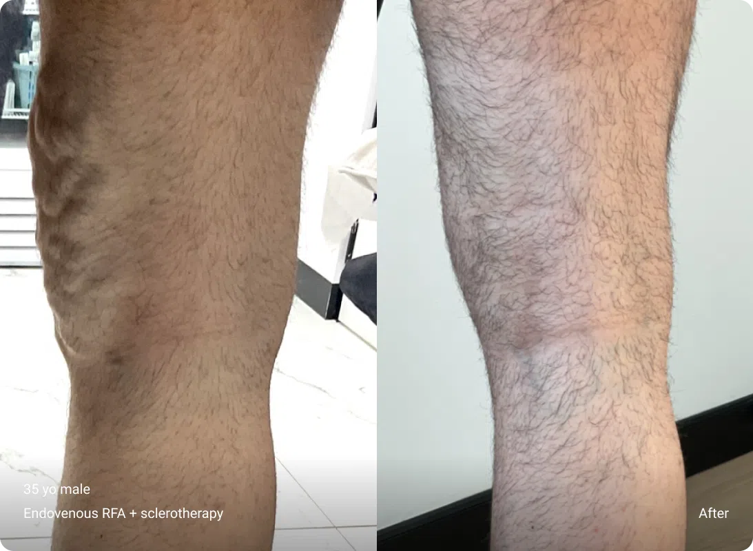 35 year old male 4 months post Endovenous RFA + sclerotherapy