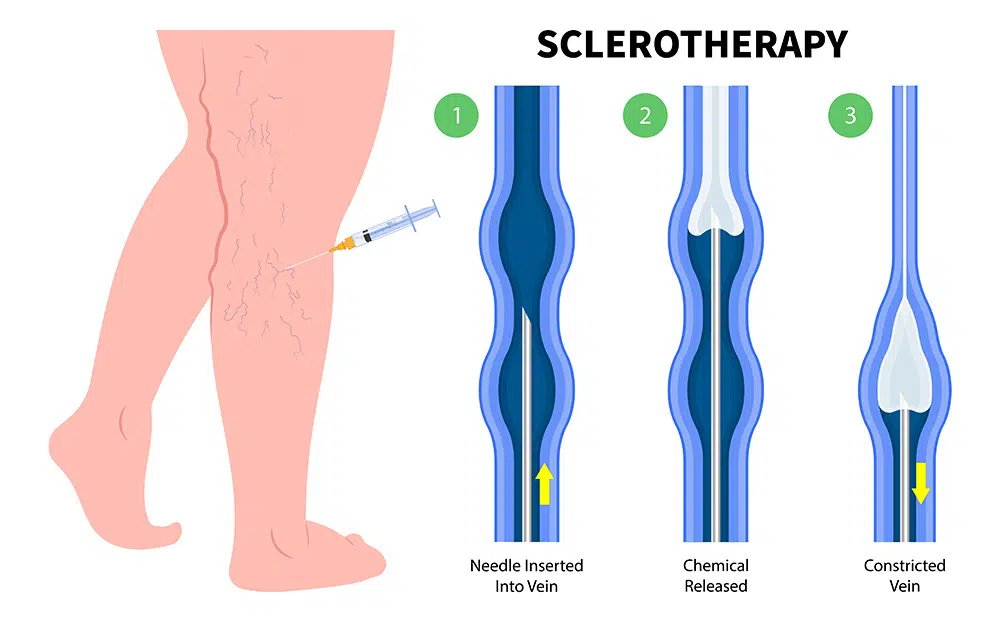 Sclerotherapy for Varicose Veins | Sclerotherapy for Spider Veins | What is Sclerotherapy