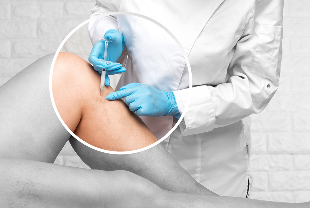 Sclerotherapy for Varicose Veins | Sclerotherapy for Spider Veins | What is Sclerotherapy