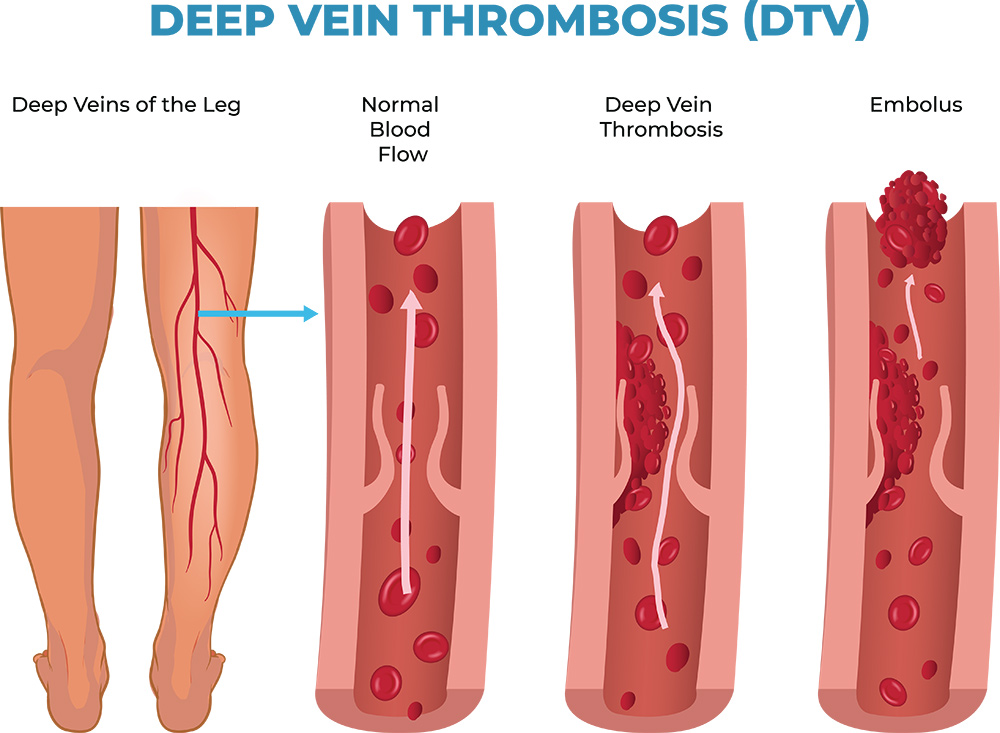 5 Types of Thrombosis | What Causes Thrombosis | What is a Thrombosis