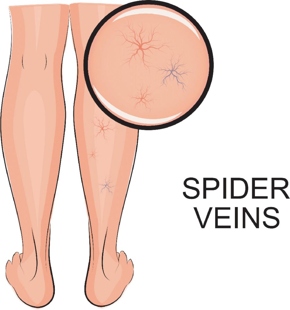 How to Get Rid of Spider Veins | What Causes Spider Veins | What Are Spider Veins