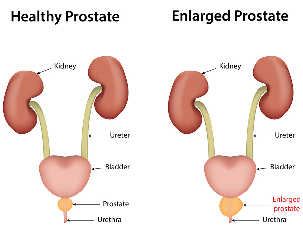 Enlarged Prostate Symptoms | BPH Symptoms | What Size of Prostate is Dangerous