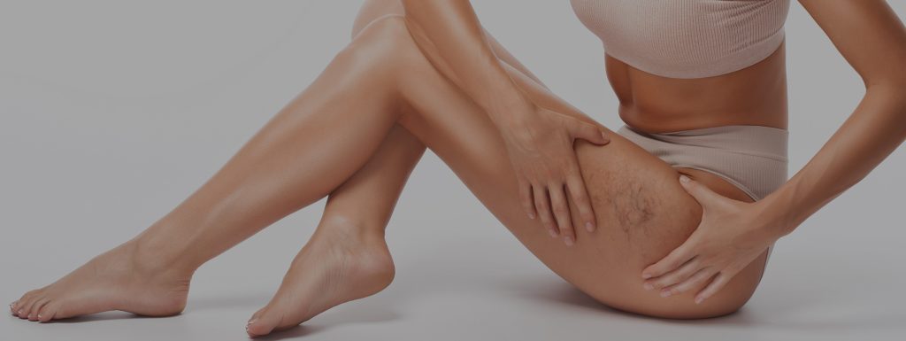 Spider Veins | Are Spider Veins Dangerous | How to Prevent Spider Veins | Can Spider Veins Go Away