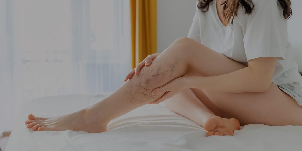 Varicose Veins in Women | Varicose Veins in Men | Causes of Varicose Veins