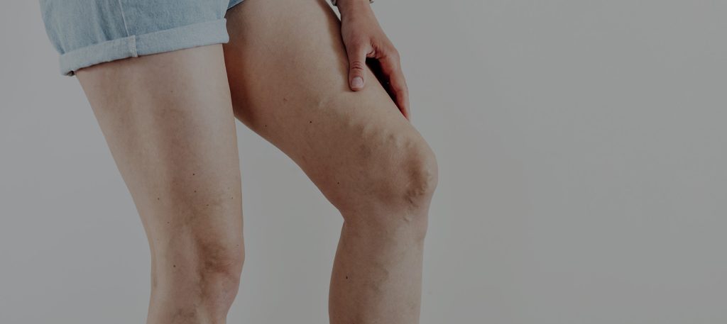 Superficial Thrombophlebitis vs DVT | DVT Symptoms | Difference Between Thrombophlebitis and DVT