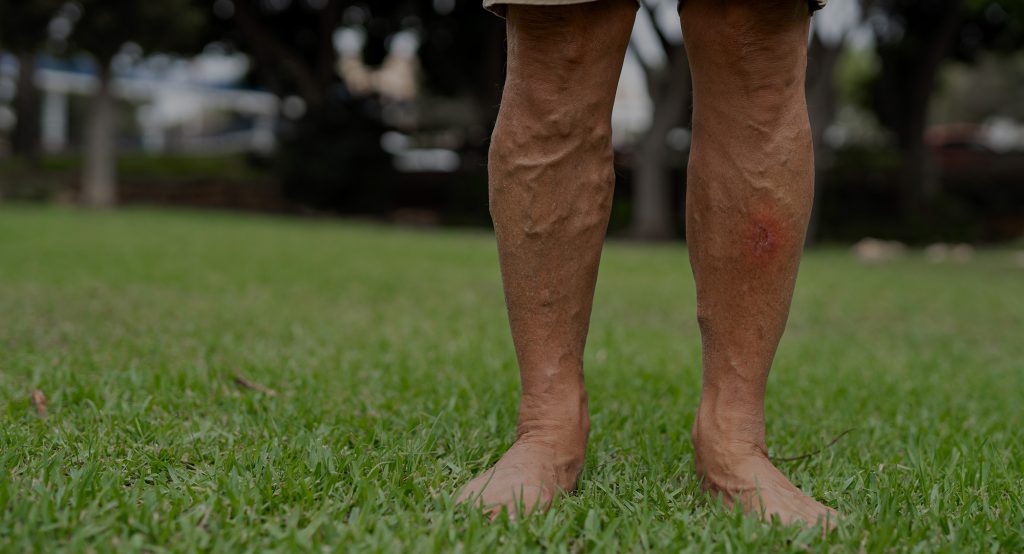 Common Varicose Vein Questions | Varicose Vein Clinic | Vein Treatment