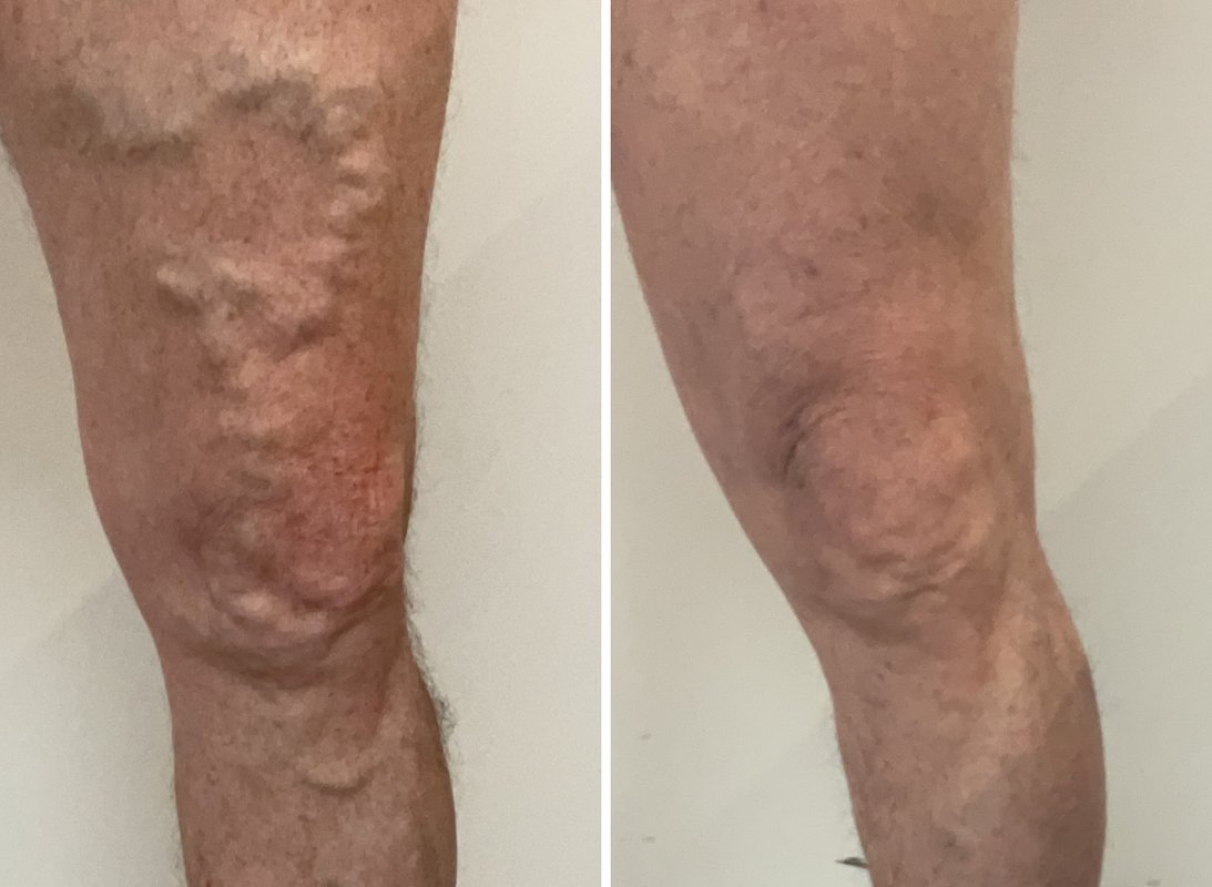 Before treatment: bulging varicose veins on the thigh and knee