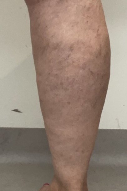 After treatment: the same calf 6 weeks after a second session