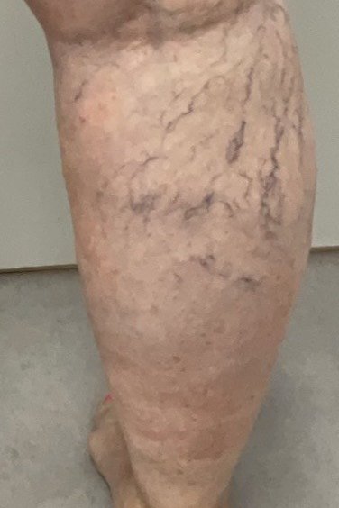 Before treatment: spider veins on the back of the calf