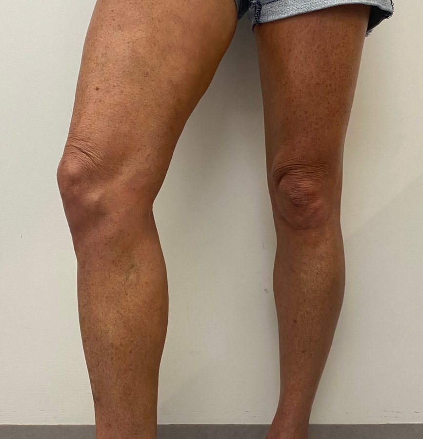 After treatment: the same legs 4 months later