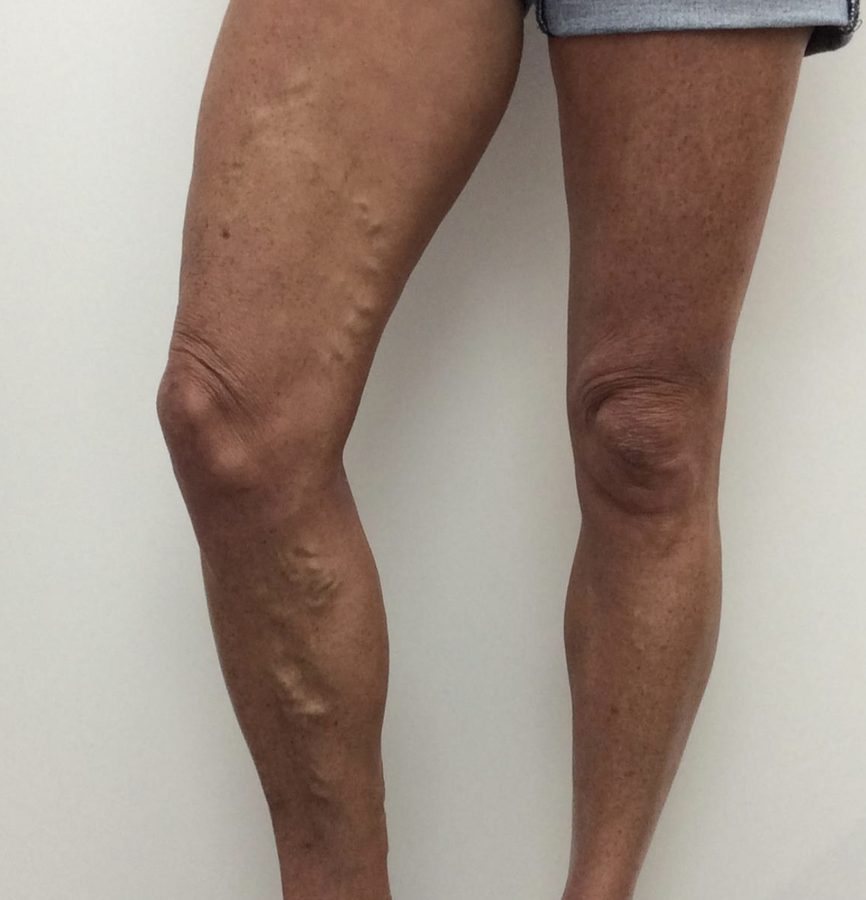 Before treatment: varicose veins on the right thigh and calf